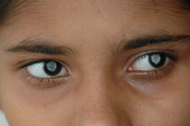 Common Myths About Cataracts Debunked