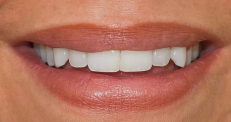 Enhancing Your Smile with Veneers and Bonding