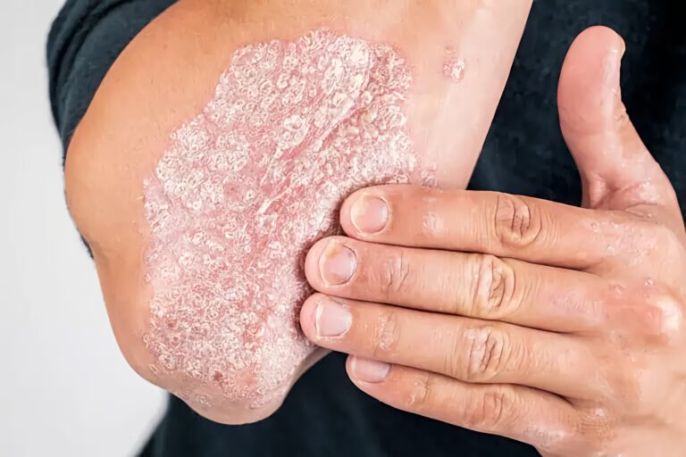 Finding a Skin Doctor for Eczema and Psoriasis Relief