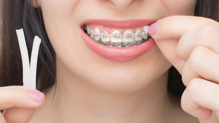 How to Manage Pain and Discomfort After Getting Braces