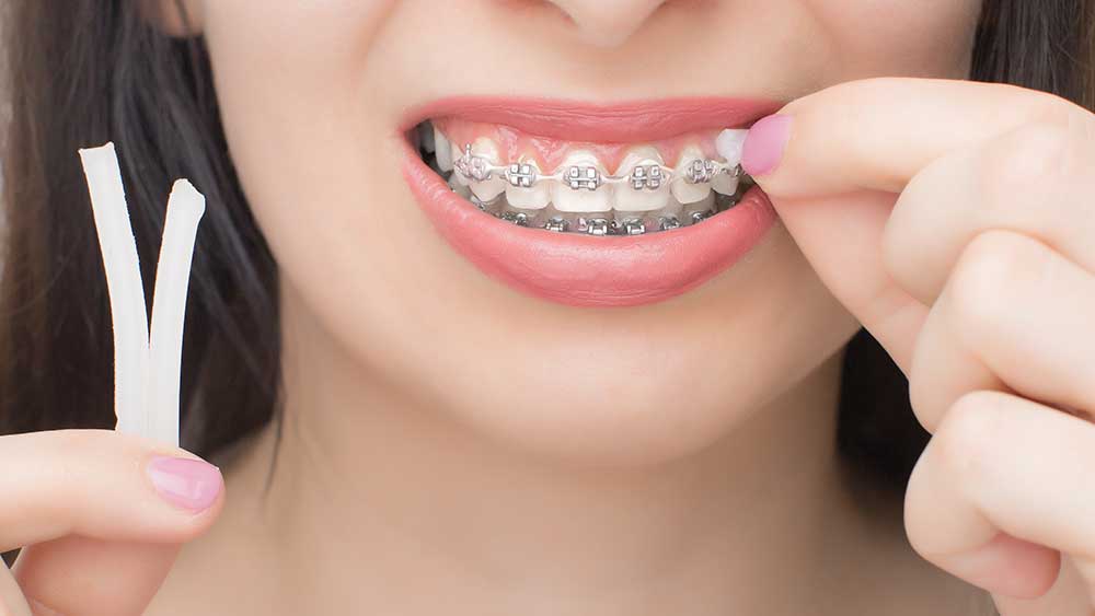 How to Manage Pain and Discomfort After Getting Braces