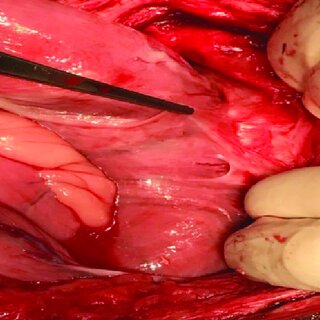 Recovery Tips After Gallbladder Surgery