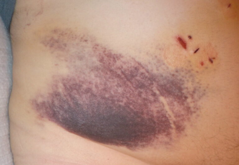 Steps To Take Following Gallbladder Surgery