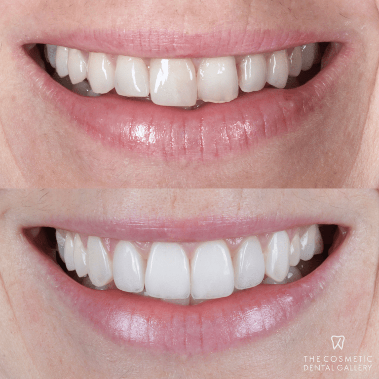 The Advantages of Porcelain Veneers