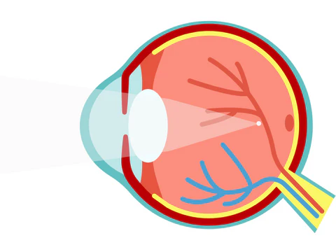 The Impact of LASIK on Quality of Life