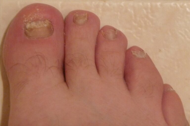 The Link Between Toe Nail Fungus and Overall Foot Health