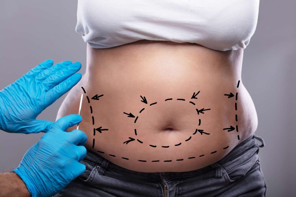 The Pros and Cons of Tummy Tucks for a Slimmer Silhouette