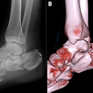 Tips for Choosing Between Ankle Replacement and Ankle Fusion
