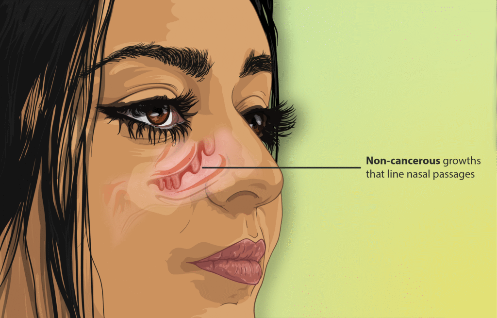 Understanding How Sinusitis Develops and the Role of Nasal Polyps in It