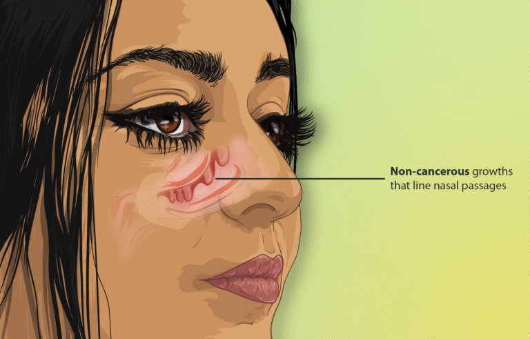 Understanding How Sinusitis Develops and the Role of Nasal Polyps in It
