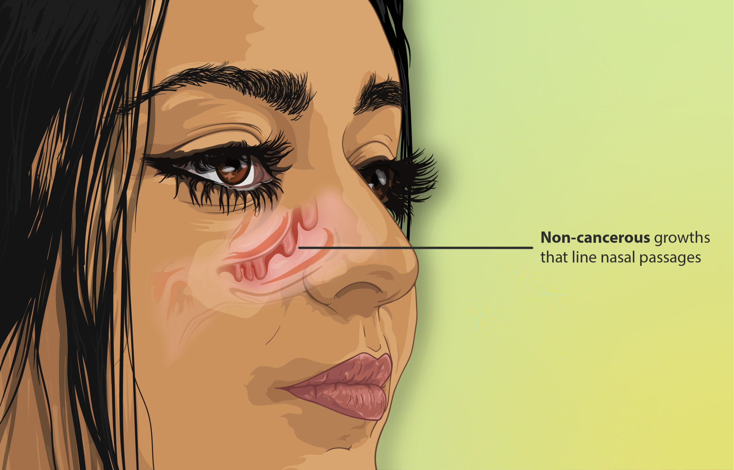 Understanding How Sinusitis Develops and the Role of Nasal Polyps in It