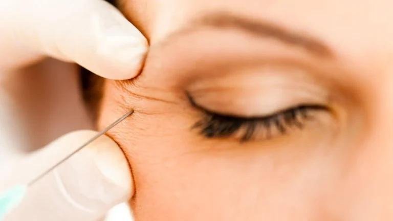 Exploring the Benefits of Botox for Fine Lines and Wrinkles