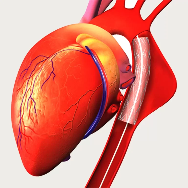 Who is not a candidate for minimally invasive bypass surgery?