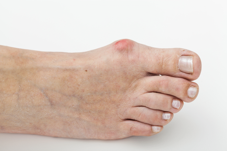 How to Treat Bunions at Home