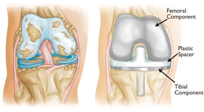 How Joint Replacement Surgery Works