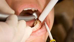 What Is a Cavity and How Is It Treated?