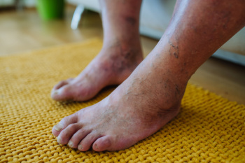 Foot Fungus and Pool Season: Tips for Protection