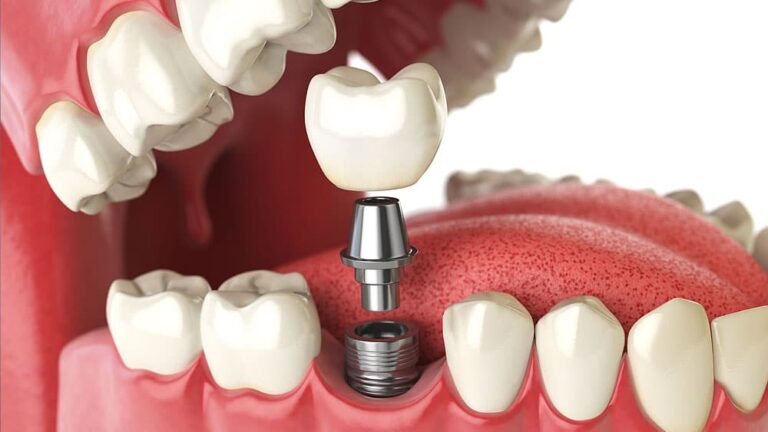 How Dental Implants Are Changing the Way We Approach Tooth Replacement