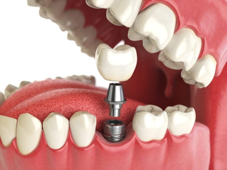 How Do Dentists Restore Missing Teeth?