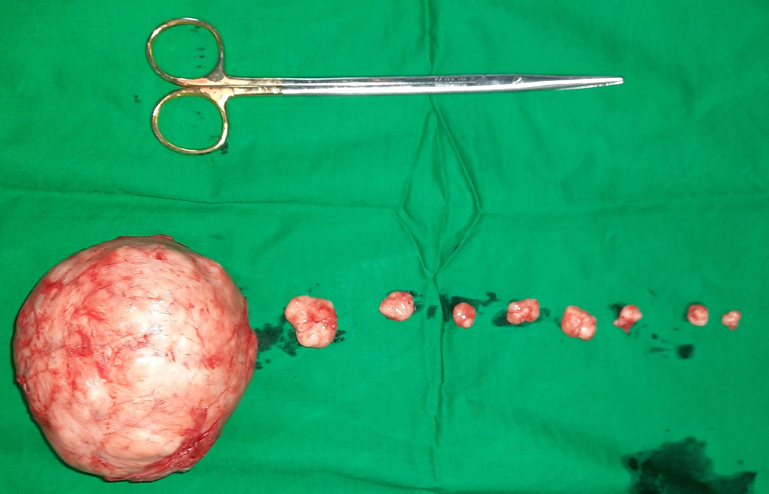 How Gynecology Plays a Key Role in Treating Uterine Fibroids
