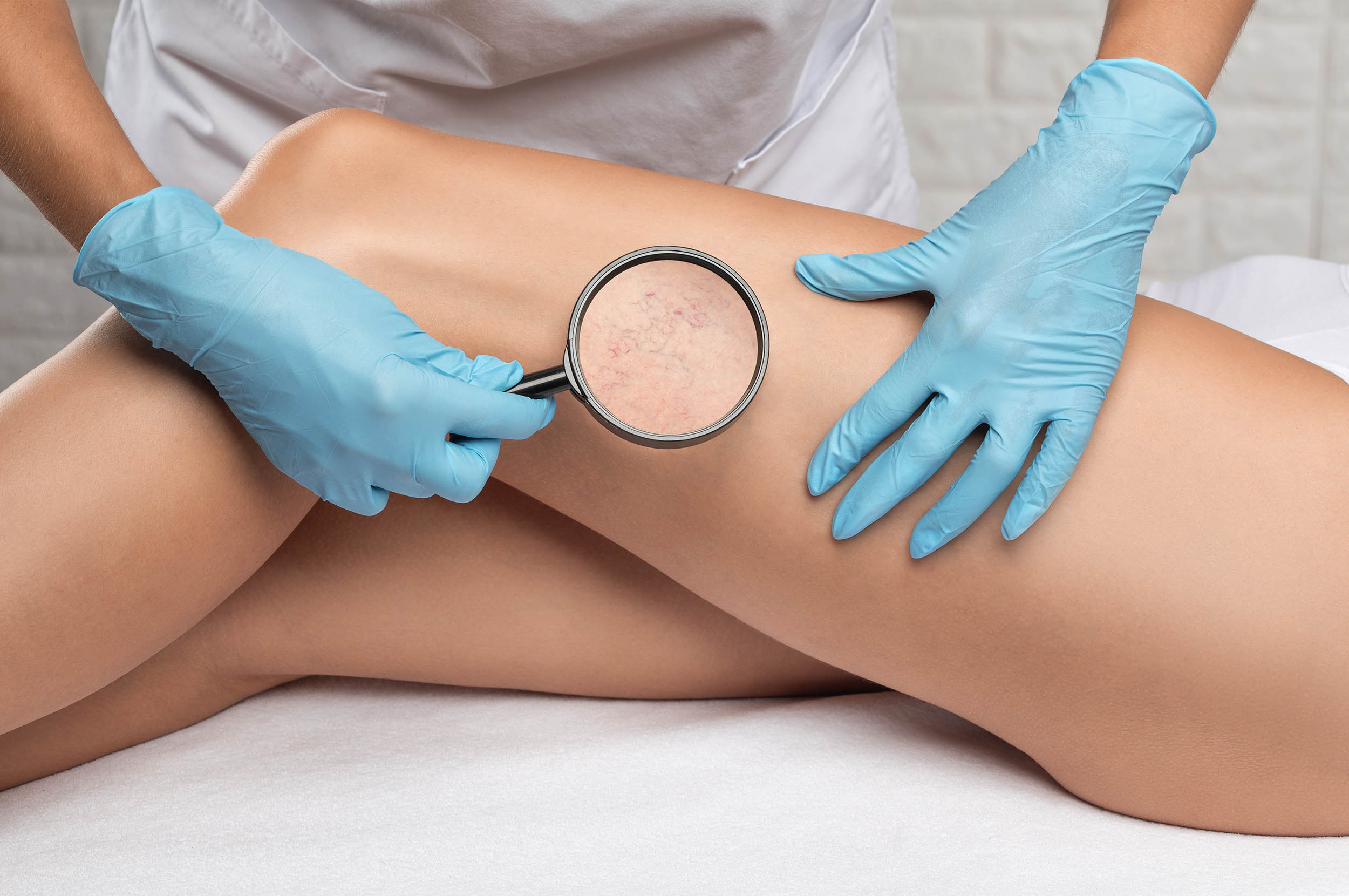 How Vein Clinics Help Treat Varicose Veins with Minimally Invasive Techniques