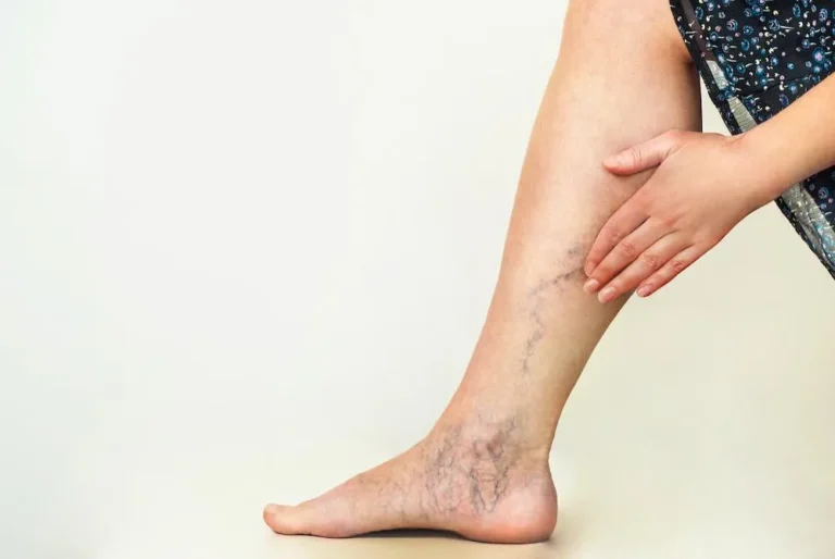 How to Prevent the Formation of New Varicose Veins