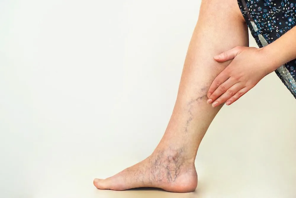 How to Prevent the Formation of New Varicose Veins