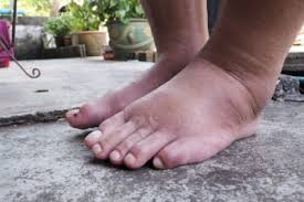 Managing Gout and Its Impact on Foot Health
