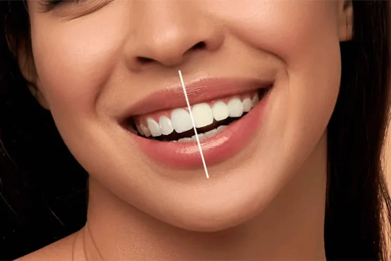 The Best Teeth Whitening Methods for Long-Lasting Results