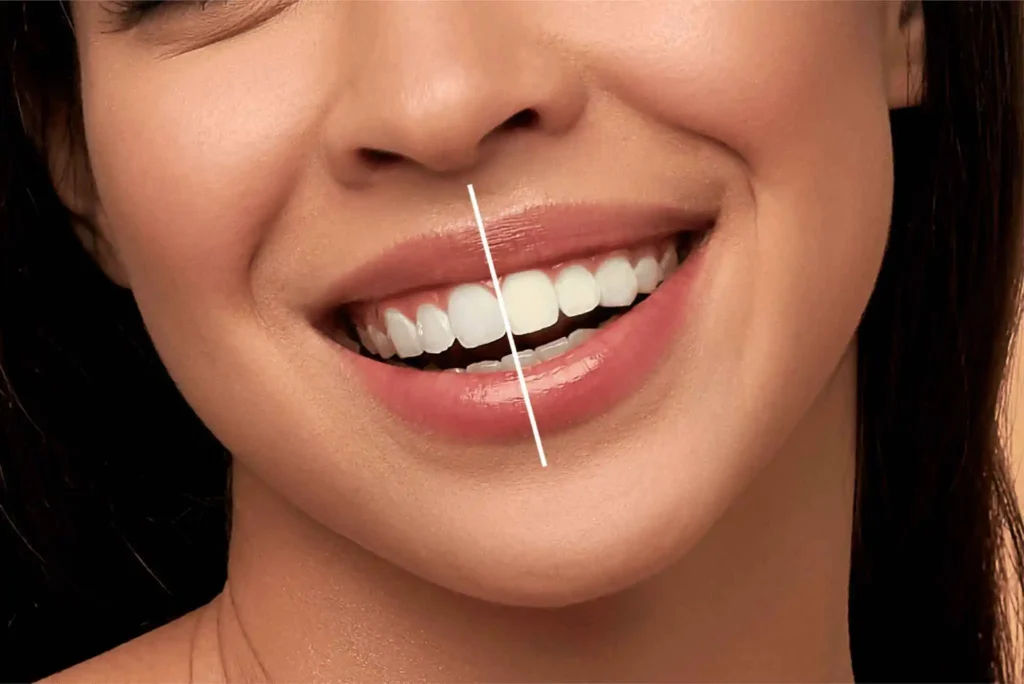 The Best Teeth Whitening Methods for Long-Lasting Results
