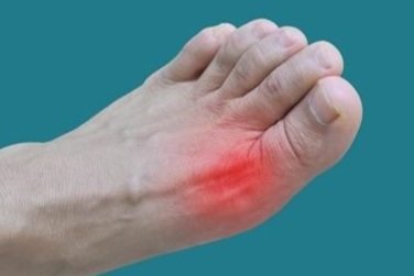 What Causes Gout and How Do I Treat It?