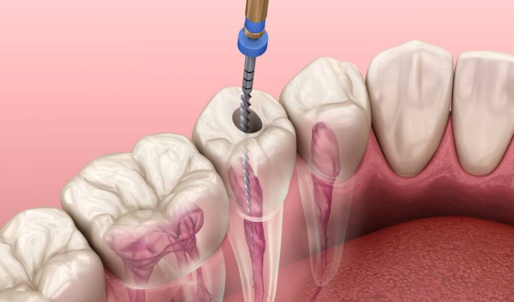 4 Steps of Regenerative Endodontic Treatment