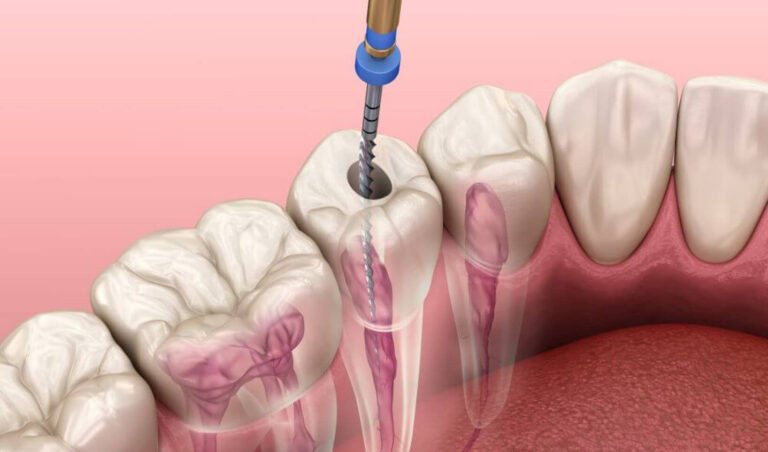 4 Steps of Regenerative Endodontic Treatment