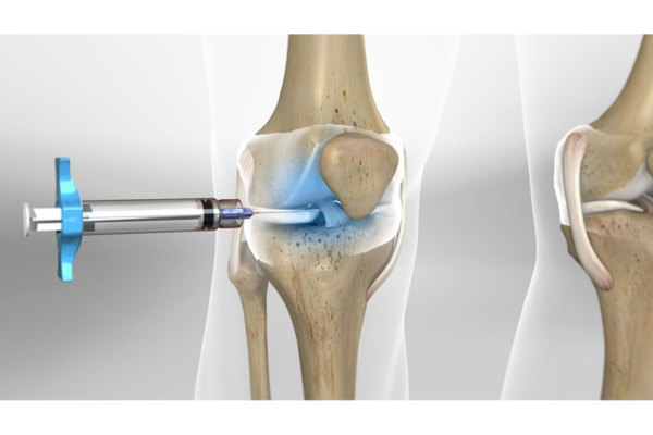 Exploring New Techniques in Joint Replacement Surgery