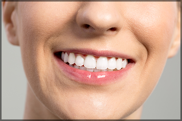 The Advantages of Veneers for a Picture-Perfect Smile