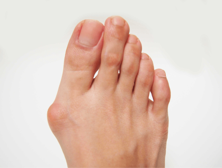 Understanding Bunion Symptoms and Treatment Options