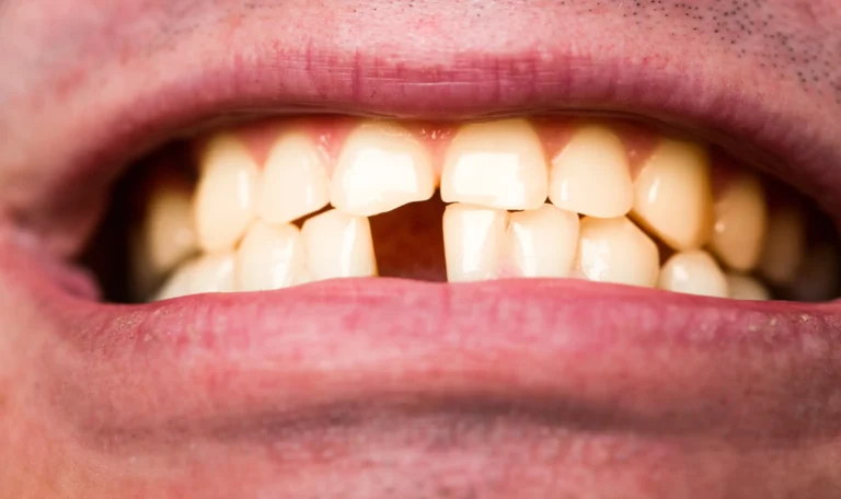 Why Teeth Cleaning is a Vital Step in Preventing Tooth Loss