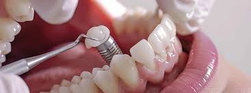 Why a Sinus Lift is Sometimes Necessary for Successful Implants