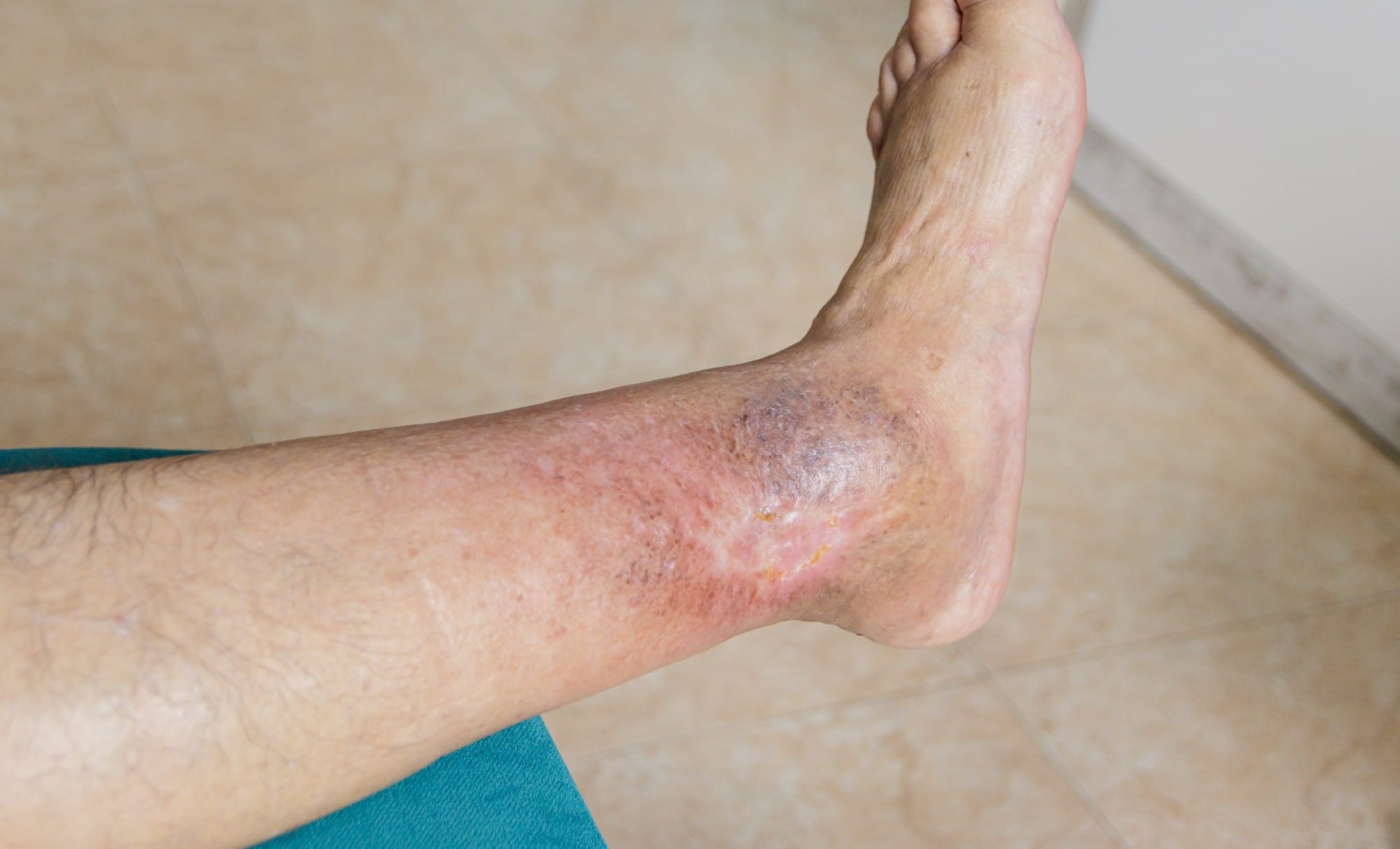 Wound Care Strategies for Faster Healing and Less Scarring