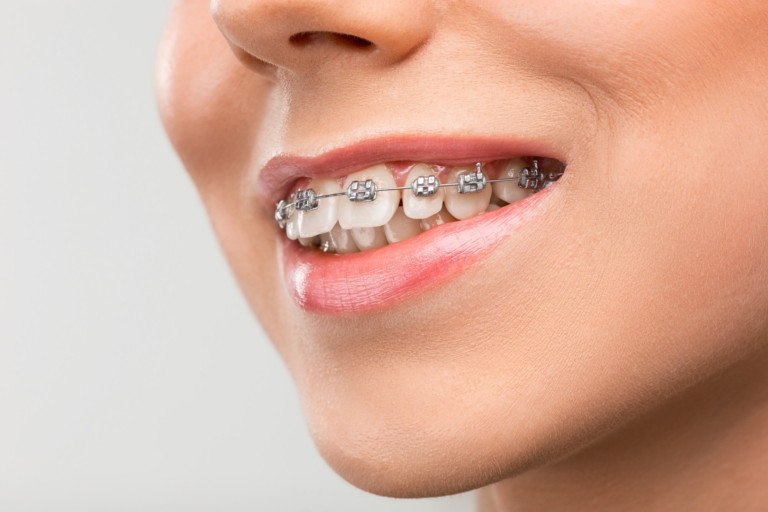 Orthodontic Treatment for Teeth Alignment Correction: A Complete Guide to a Healthier and More Confident Smile