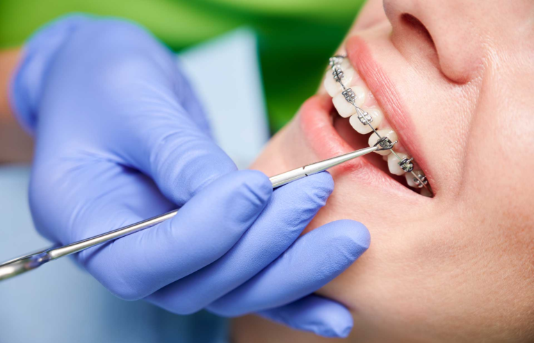 Braces and Orthodontic Treatment Options